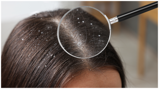 The Top 5 Mistakes People Make When Treating a Dry Scalp