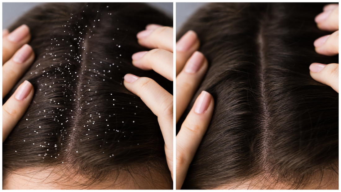 Why Your Scalp Is Itchy — And How to Fix It (Fast)